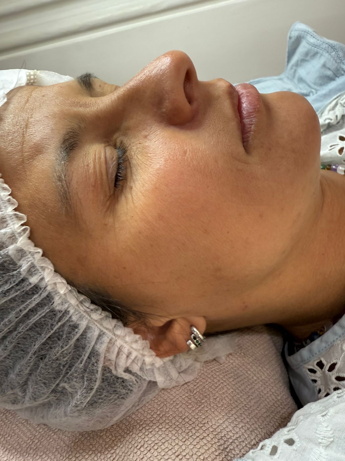 Antes del tratamiento facial