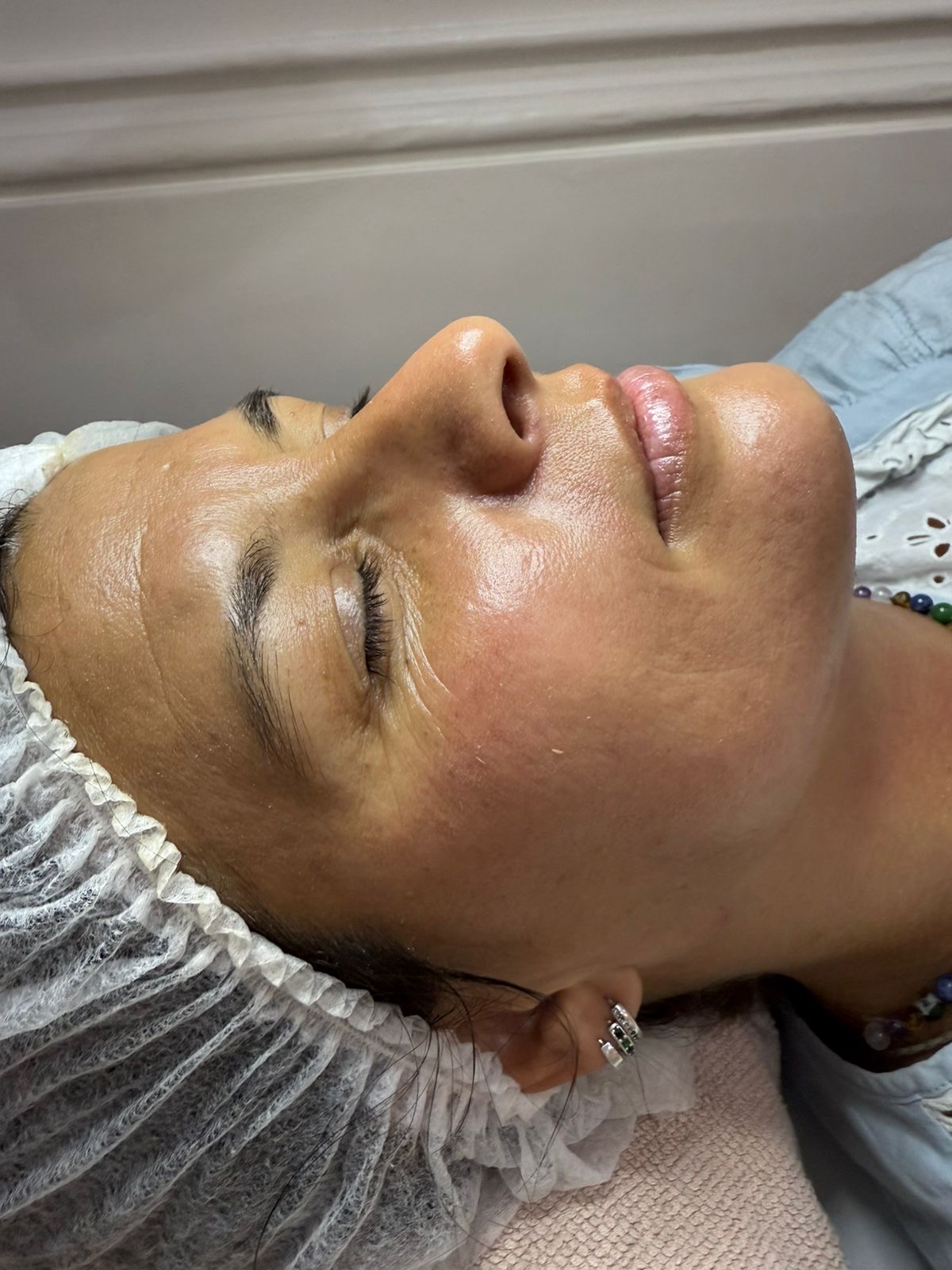 Después del tratamiento facial